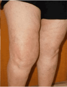 Lymphedema Therapy Before and After Pictures Sugar Land, TX