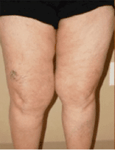 Lymphedema Therapy Before and After Pictures Sugar Land, TX