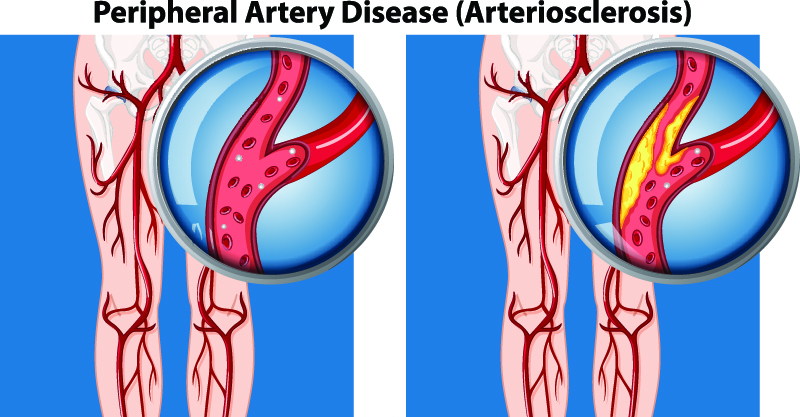 Peripheral Arterial Disease in South Texas