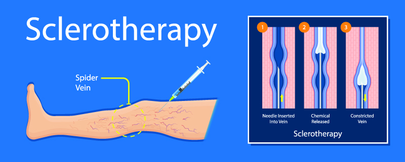 Sclerotherapy in South Texas Area