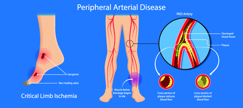 Critical Limb Ischemia in South Texas Area