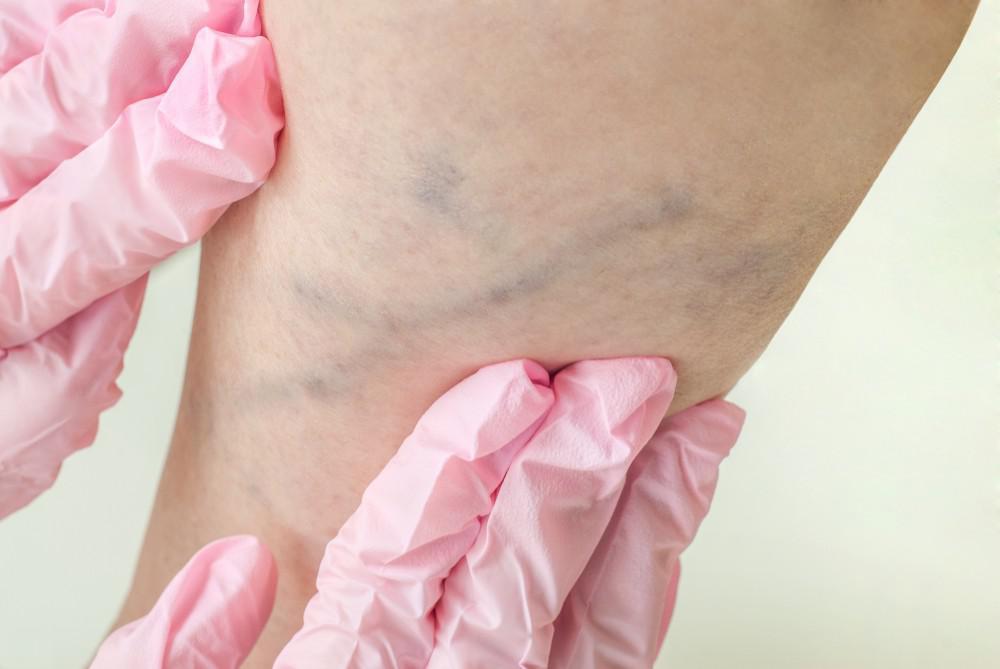 When are Varicose Veins More than Just a Cosmetic Concern?