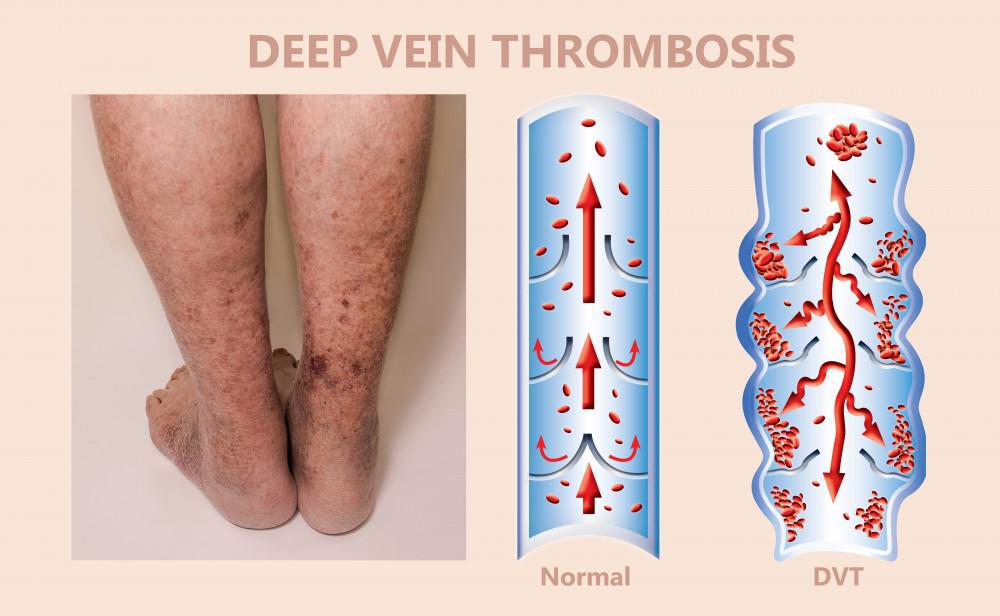 breedtegraad Bevatten Kracht Puffy Legs are One of the First Signs of Deep Vein Thrombosis - Hamilton  Vascular