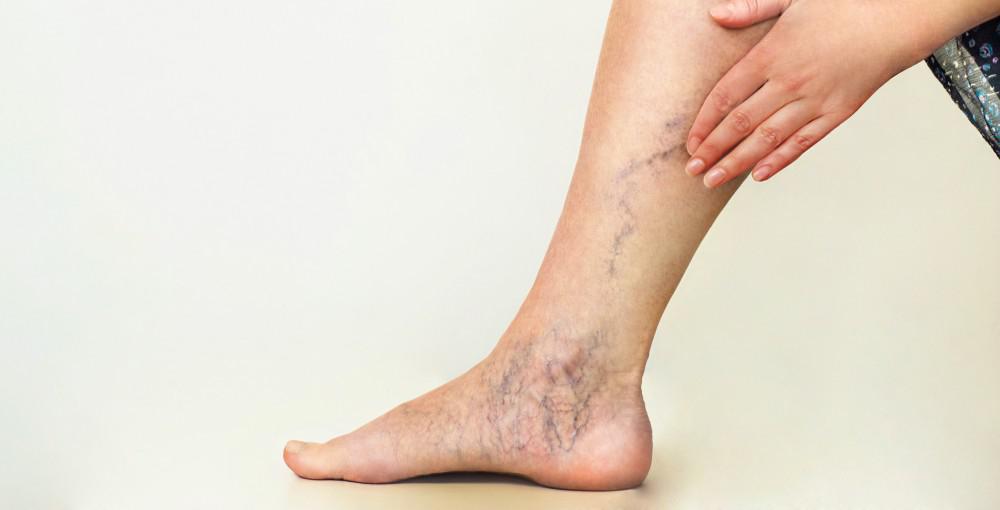 Noncosmetic Reasons to Get Rid of Your Spider Veins