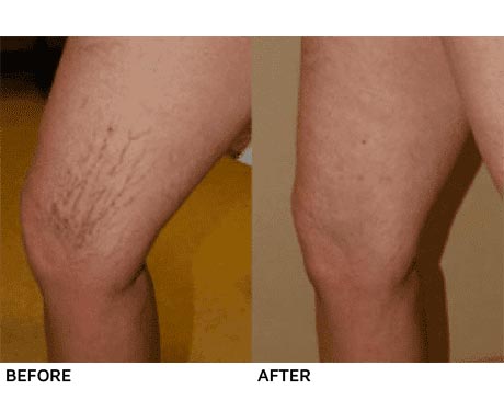 Hamilton Vascular Before and After Pictures South Texas