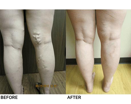 Hamilton Vascular Before and After Pictures South Texas