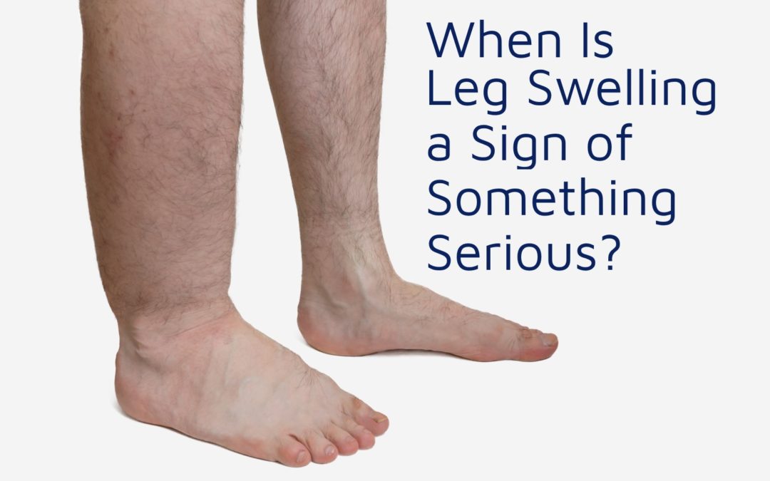 moord Conform Auroch When Is Leg Swelling a Sign of Something Serious? - Hamilton Vascular