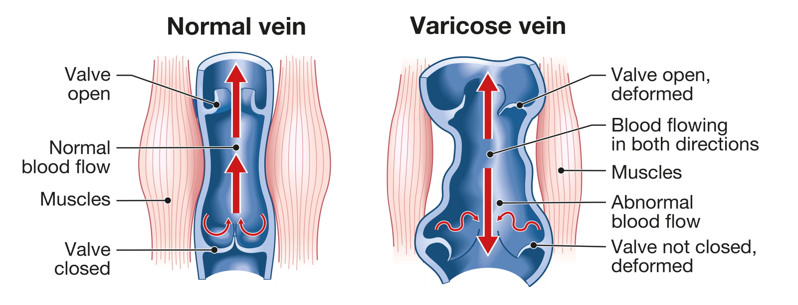 leg pain Illustration showing varicose veins and normal veins