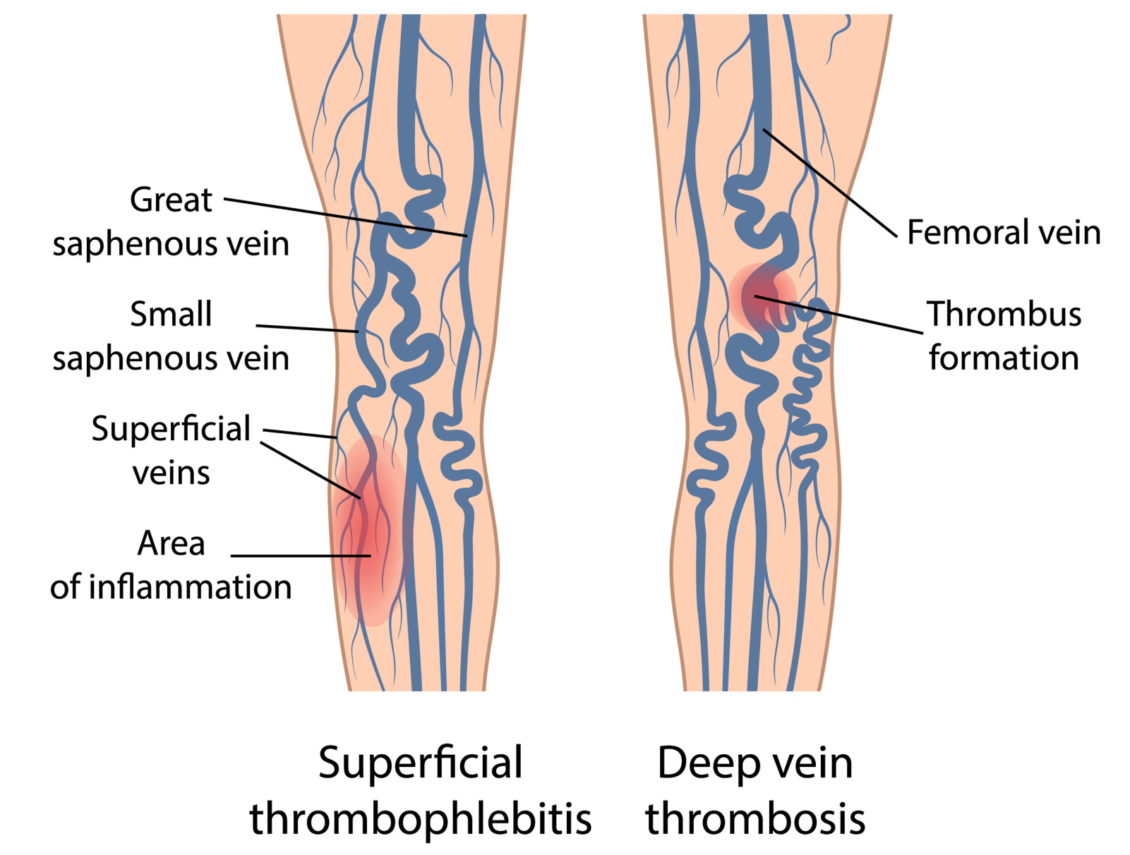 leg pain illustration venous system