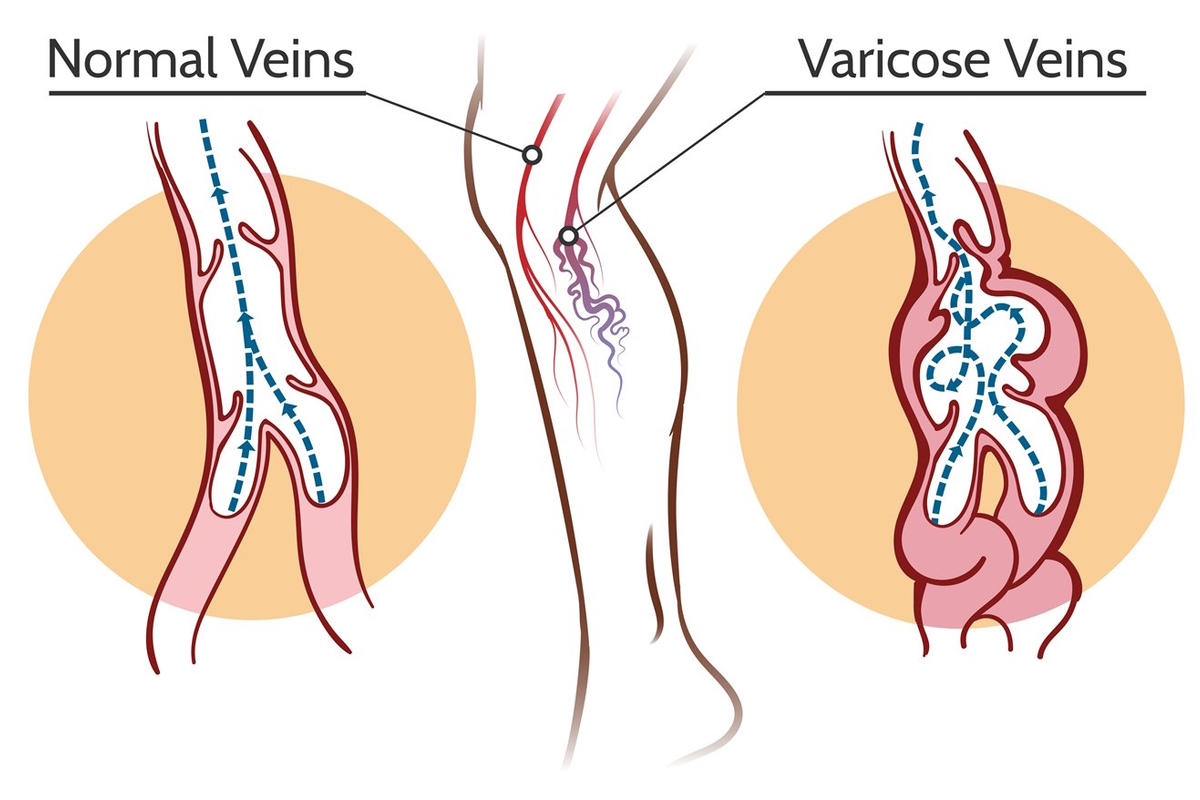 varicose veins illustration