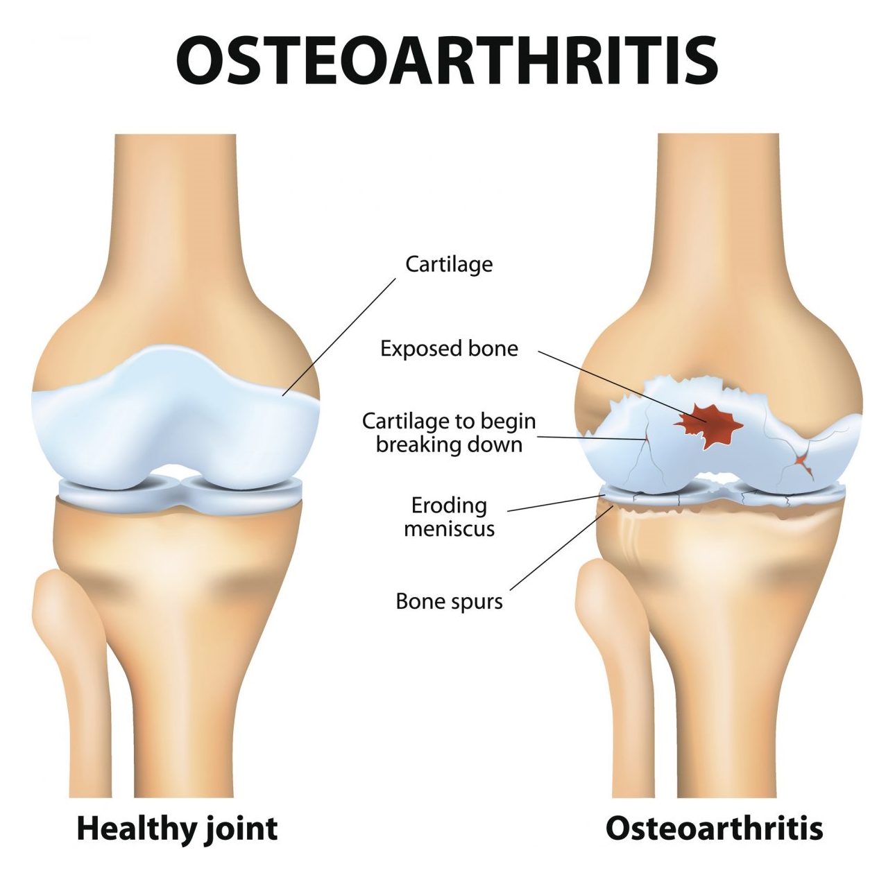 osteoarthritis knee pain illustration