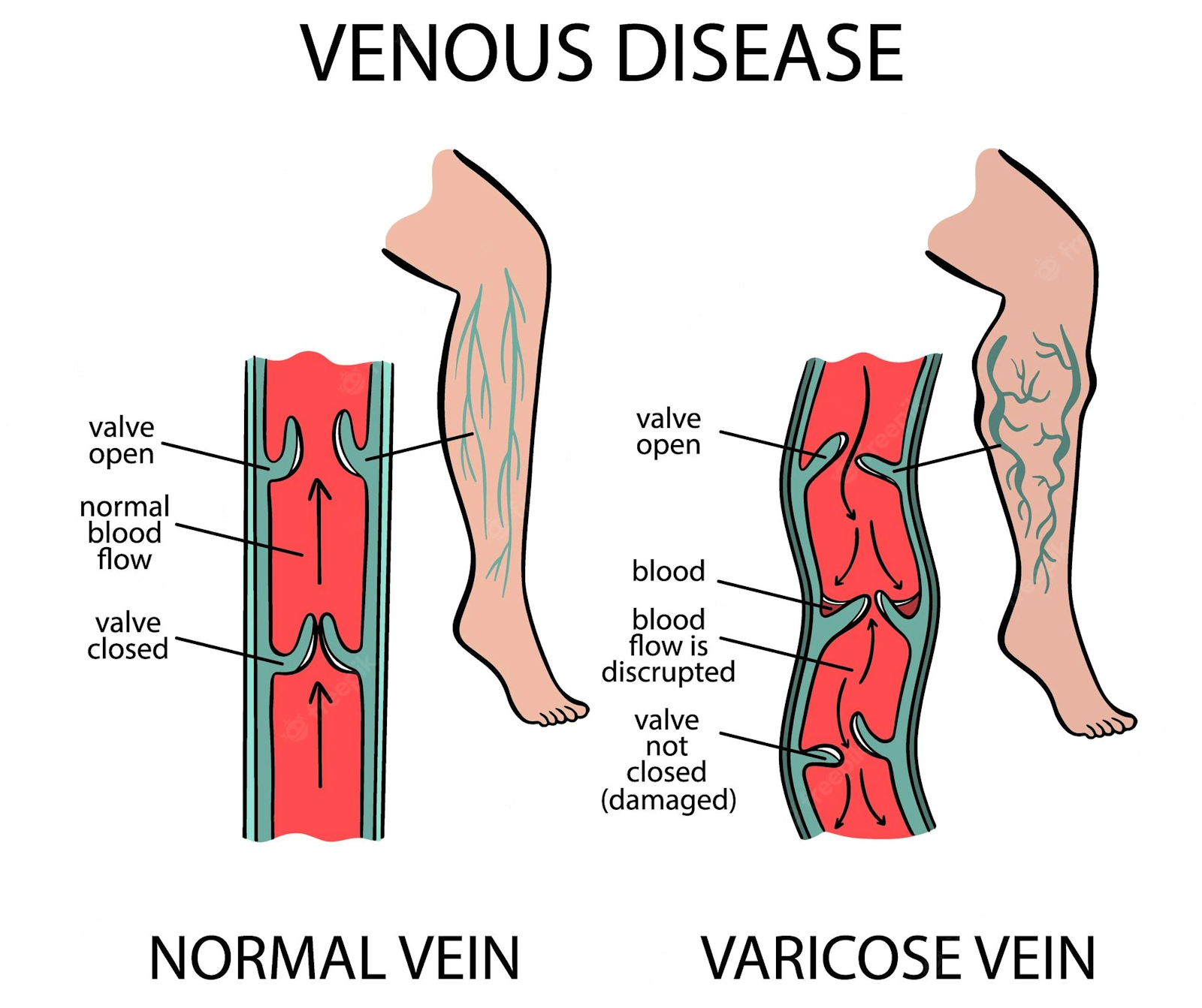 leg-pain_illustration-varicose-veins-venous-disease