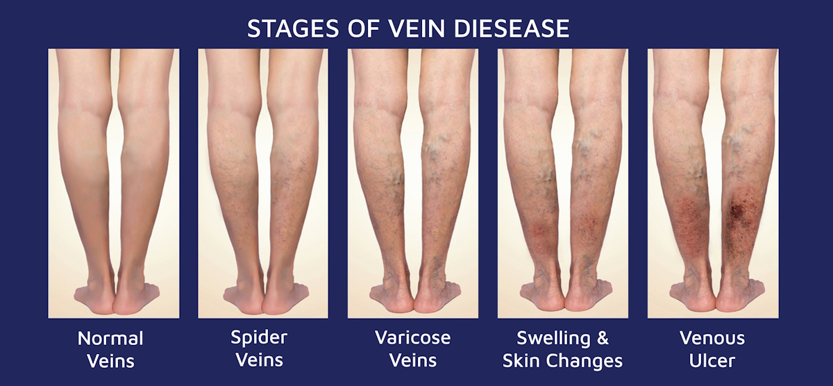vein disease stages vein disease