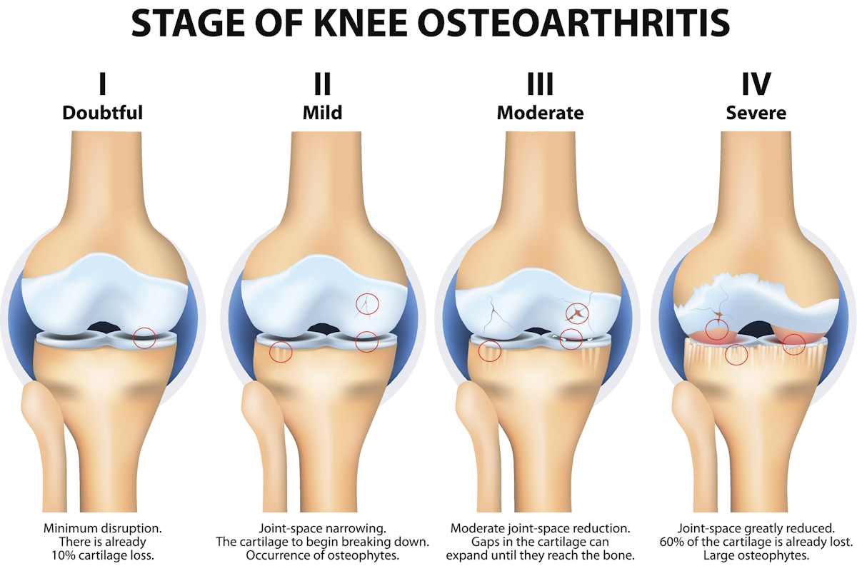 knee osteoarthritis Stages