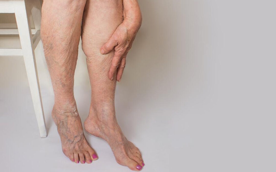 Yes, Spider VVeins Can Occur in Your 20s and 30s - StrideCare